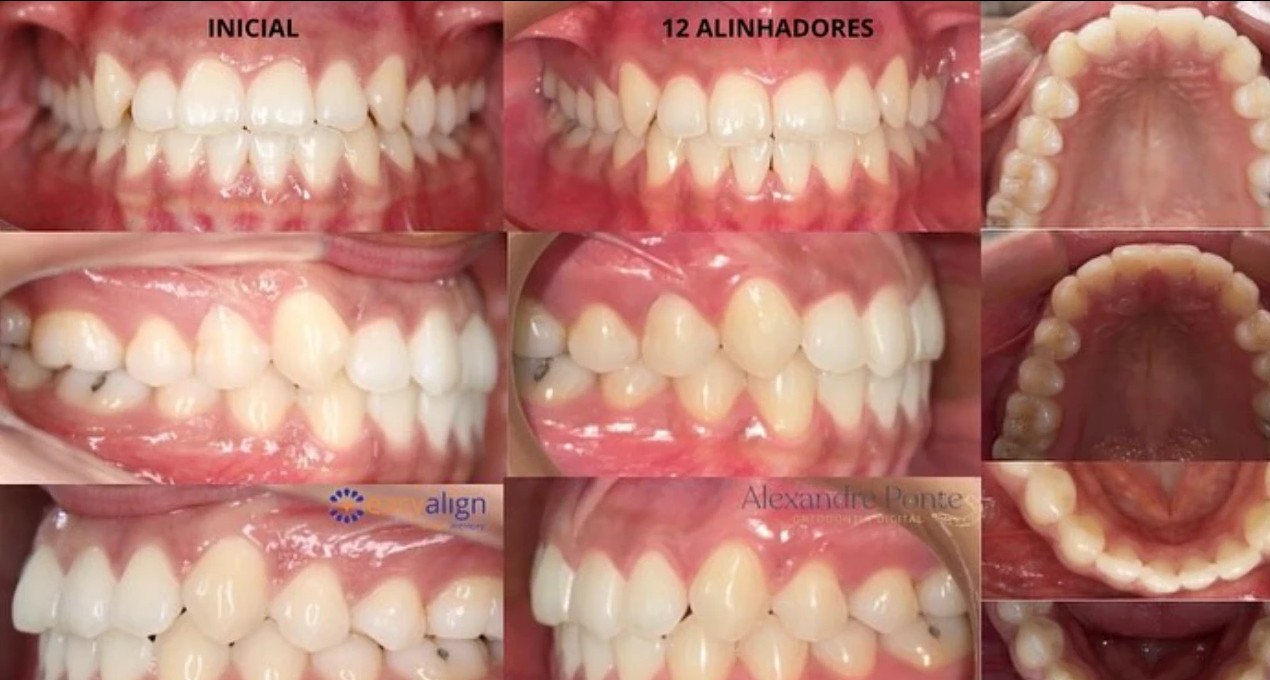 Caso 2: fotos iniciais e após 12 alinhadores