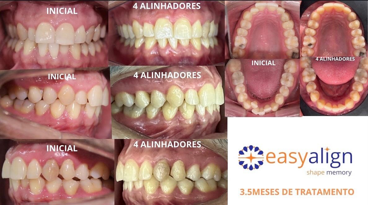 Caso 3: fotos iniciais e após 4 alinhadores