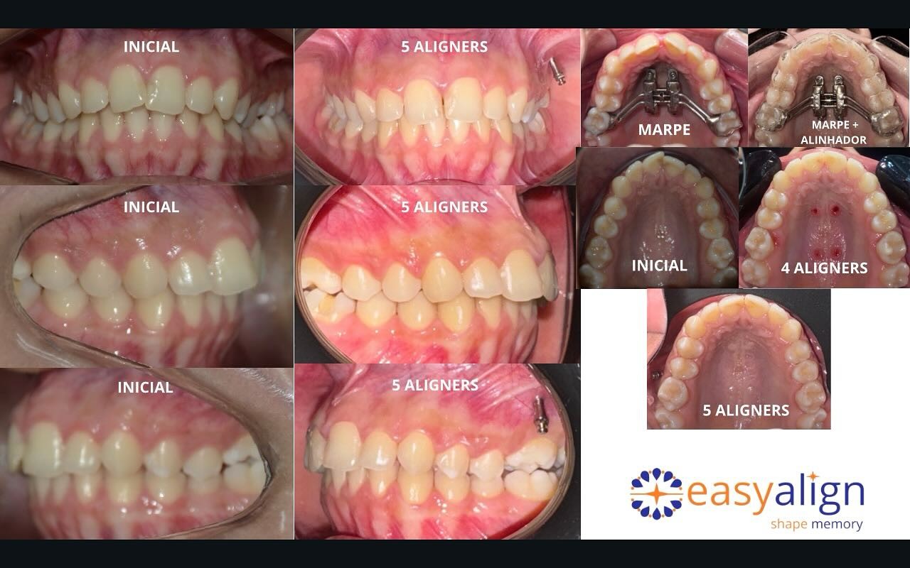 Caso 4: fotos iniciais e após 5 alinhadores com expansor MARPE